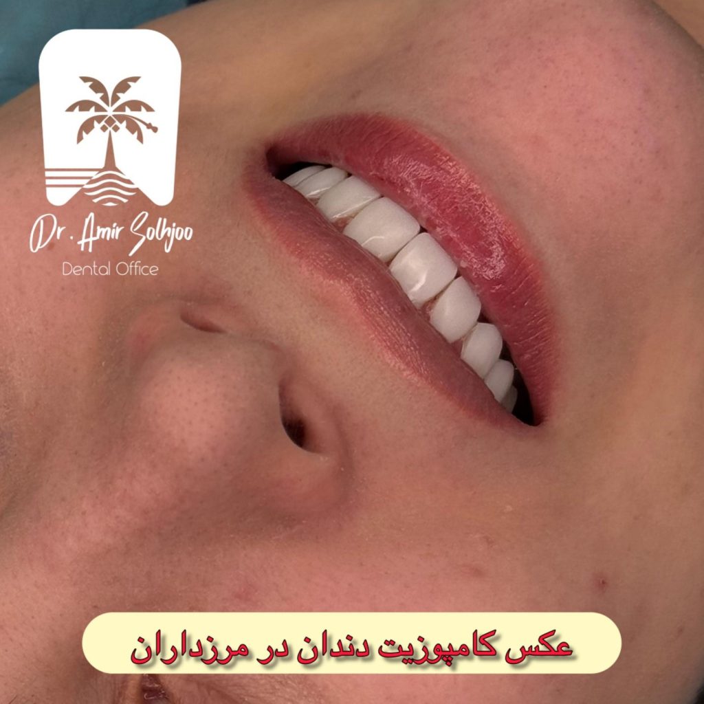 بهترین دکتر کامپوزیت تهران