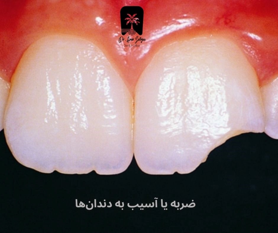 ضربه یا آسیب به دندانها