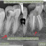 قیمت عصبکشی دندان در مرزداران تهران