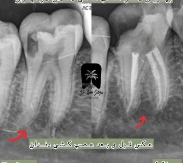 قیمت عصبکشی دندان در مرزداران تهران