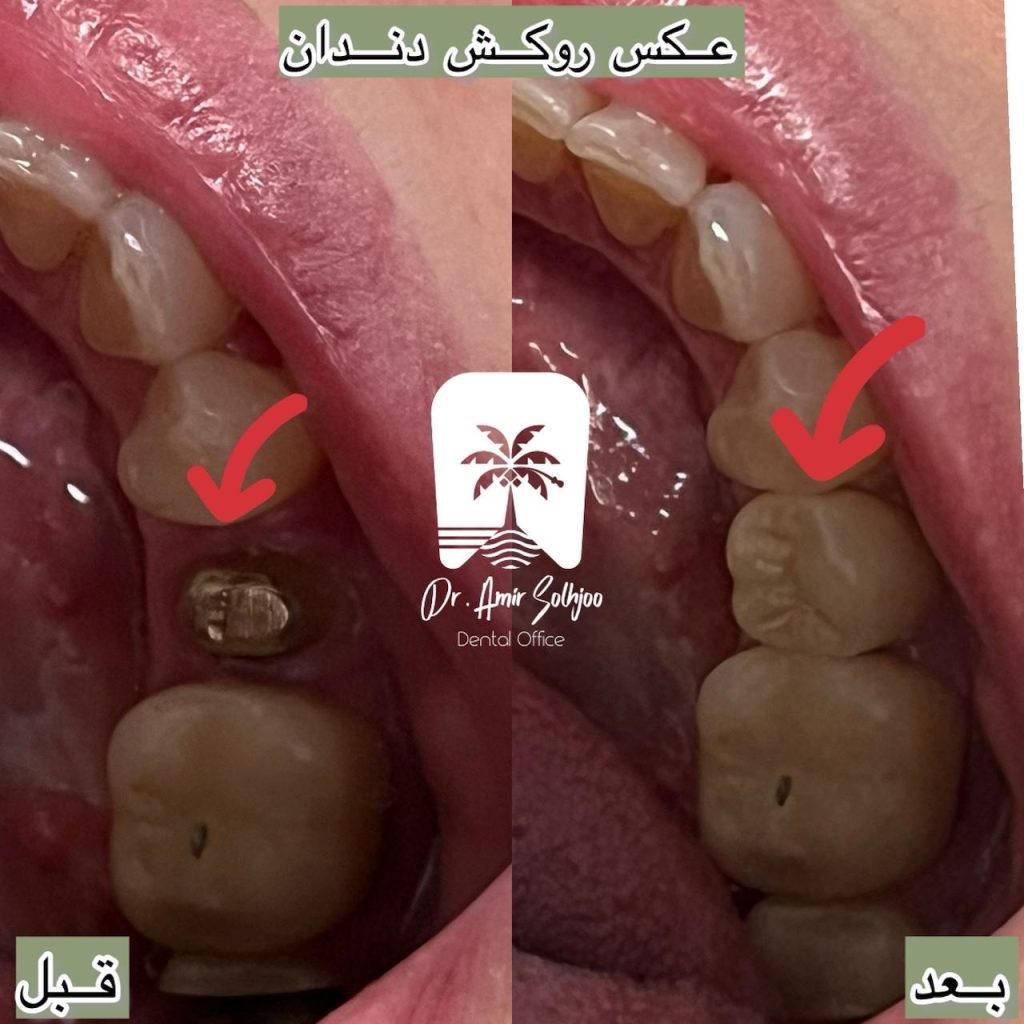 قیمت عصبکشی دندان در مرزداران تهران