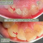 قیمت پرکردن دندان جلو