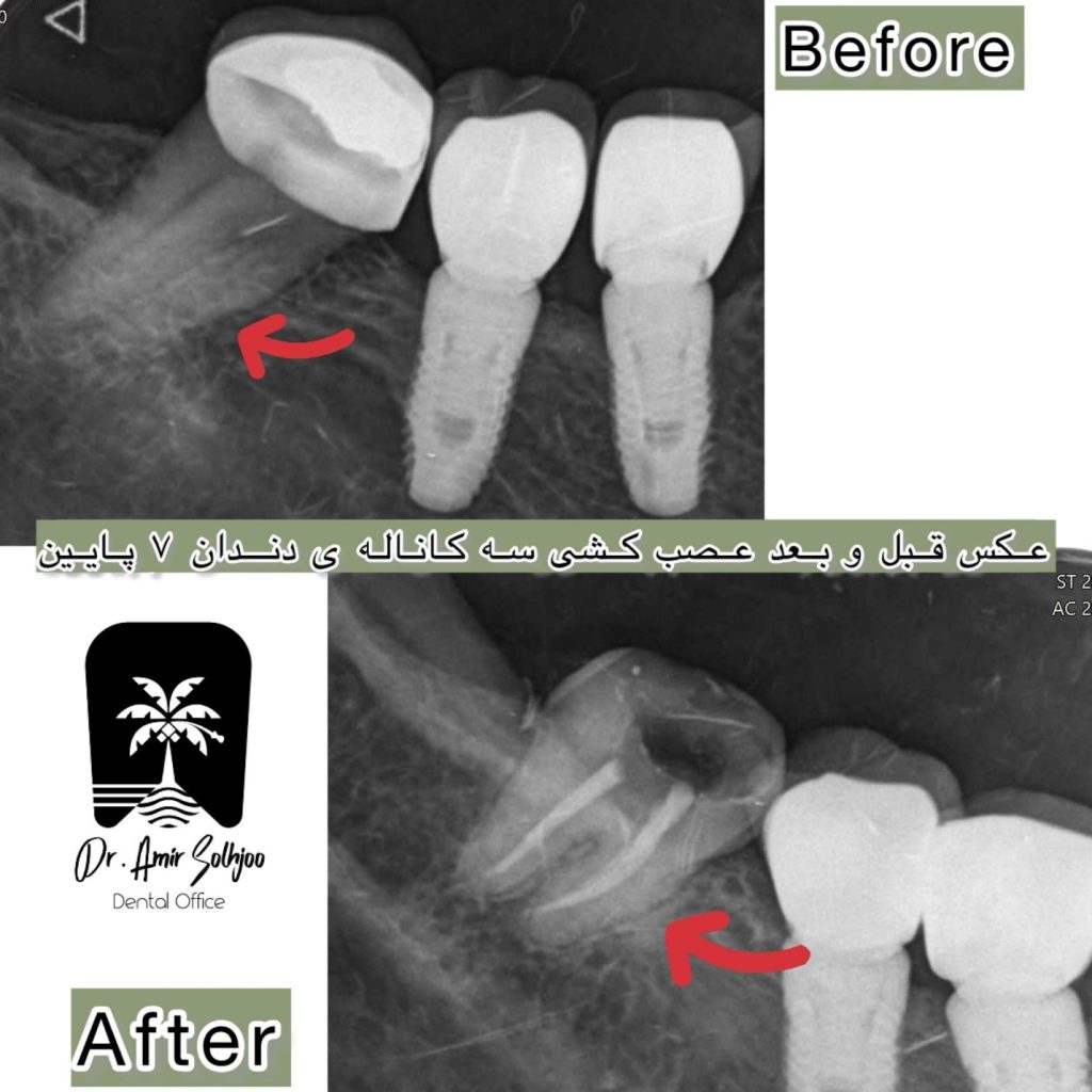 قیمت عصبکشی دندان در مرزداران تهران