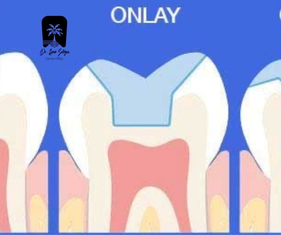 هزینه آنله سرامیکی