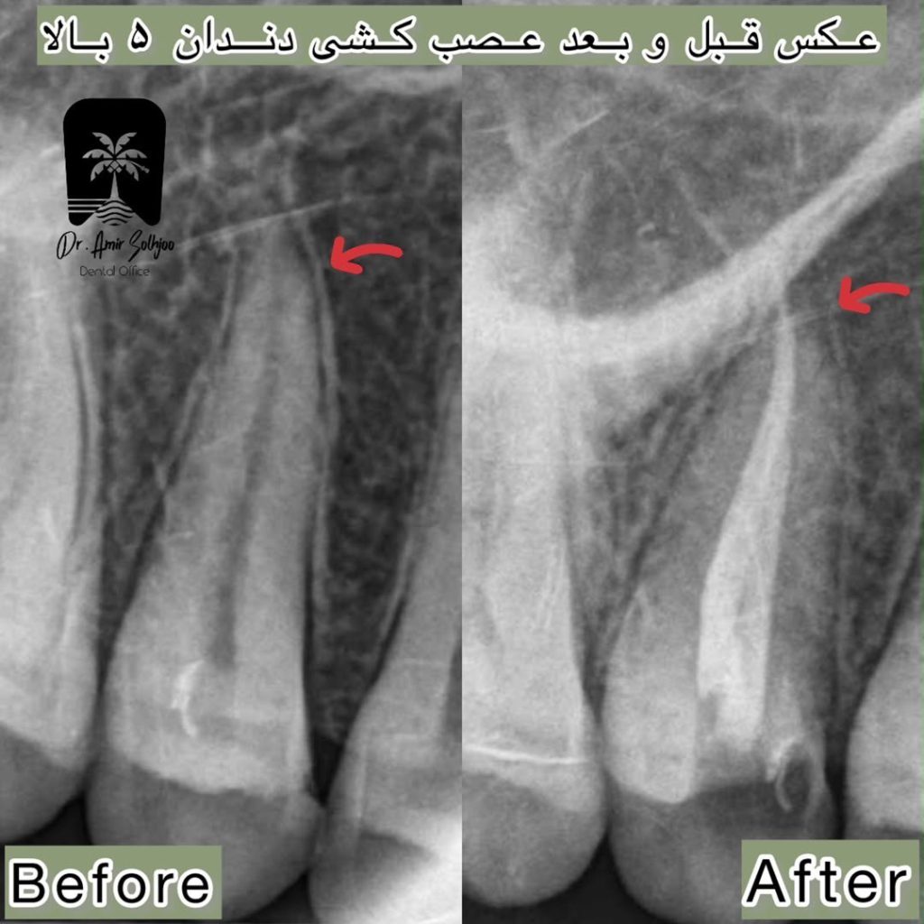 قیمت عصبکشی دندان در مرزداران تهران
