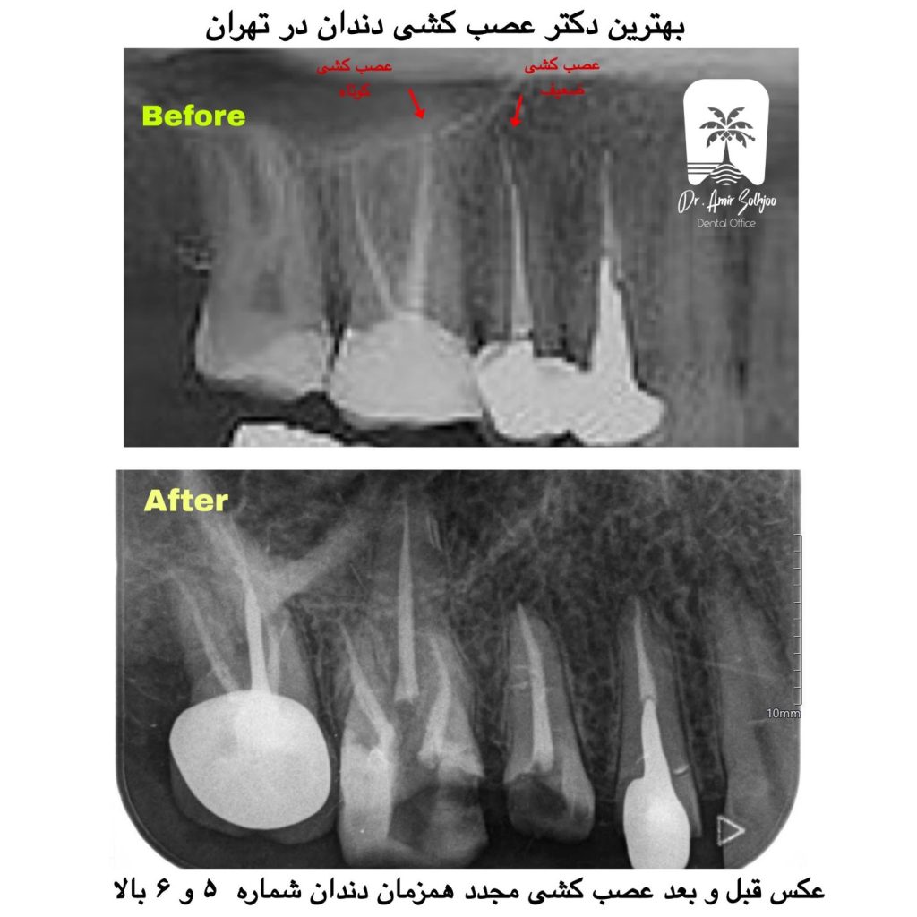 قیمت عصبکشی دندان در مرزداران تهران