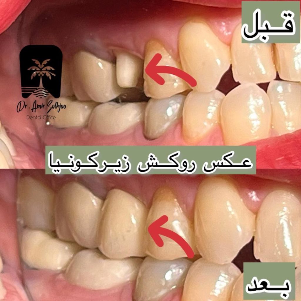 قیمت عصبکشی دندان در مرزداران تهران