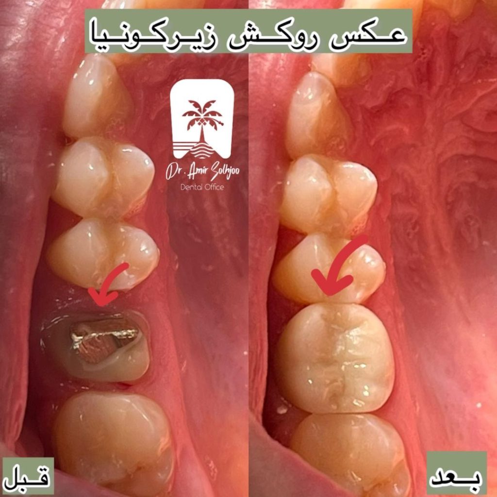 قیمت عصبکشی دندان در مرزداران تهران