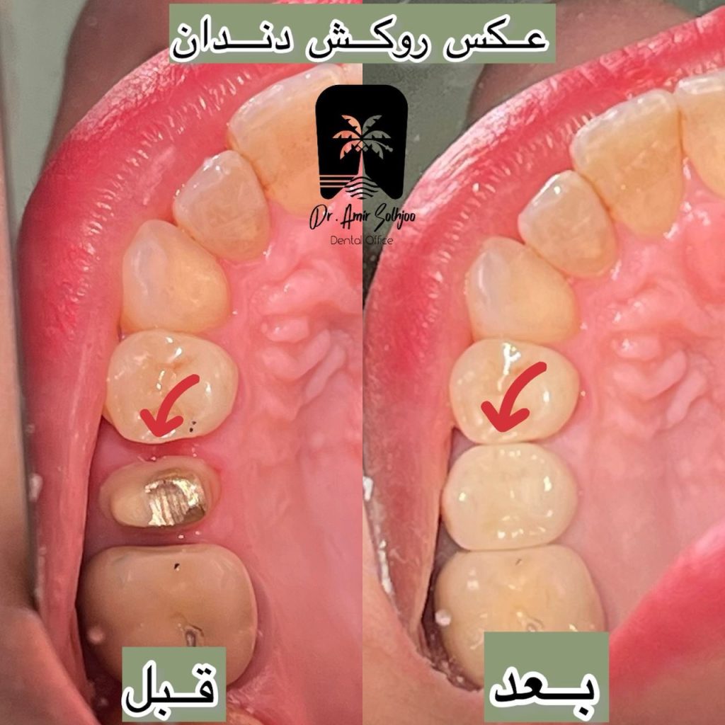 قیمت عصبکشی دندان در مرزداران تهران