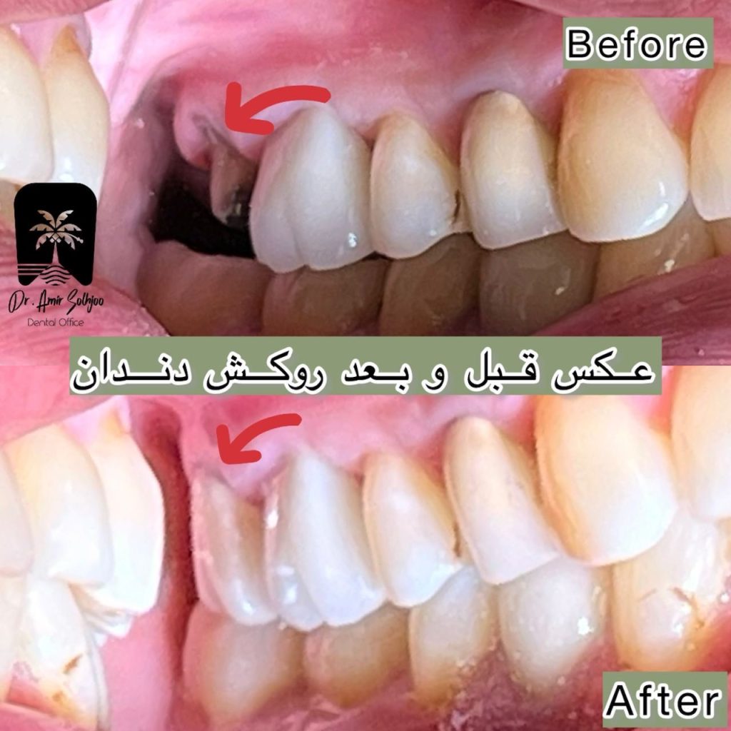 قیمت عصبکشی دندان در مرزداران تهران