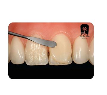 تکنیک لایه‌گذاری کامپوزیت
