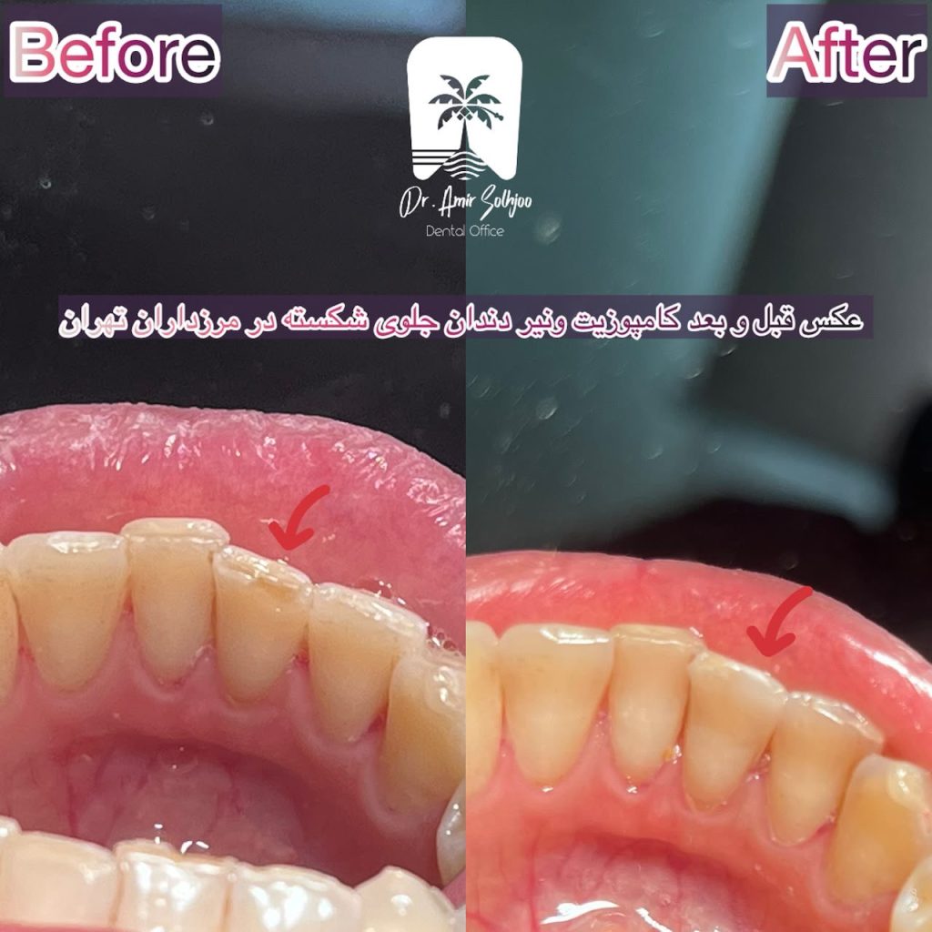 بهترین مرکز کامپوزیت دندان
