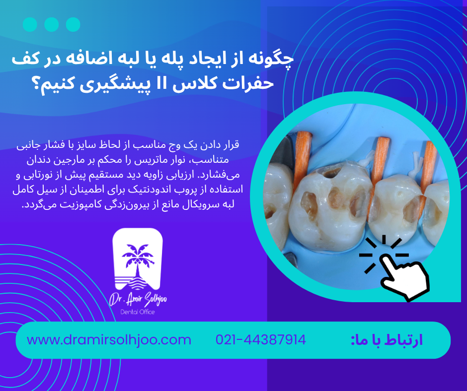 مراحل ترمیم کامپوزیت کلاس I تا V