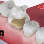 قیمت آنله دندان