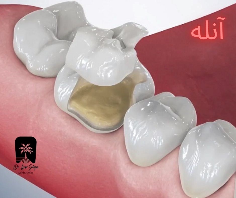قیمت آنله دندان