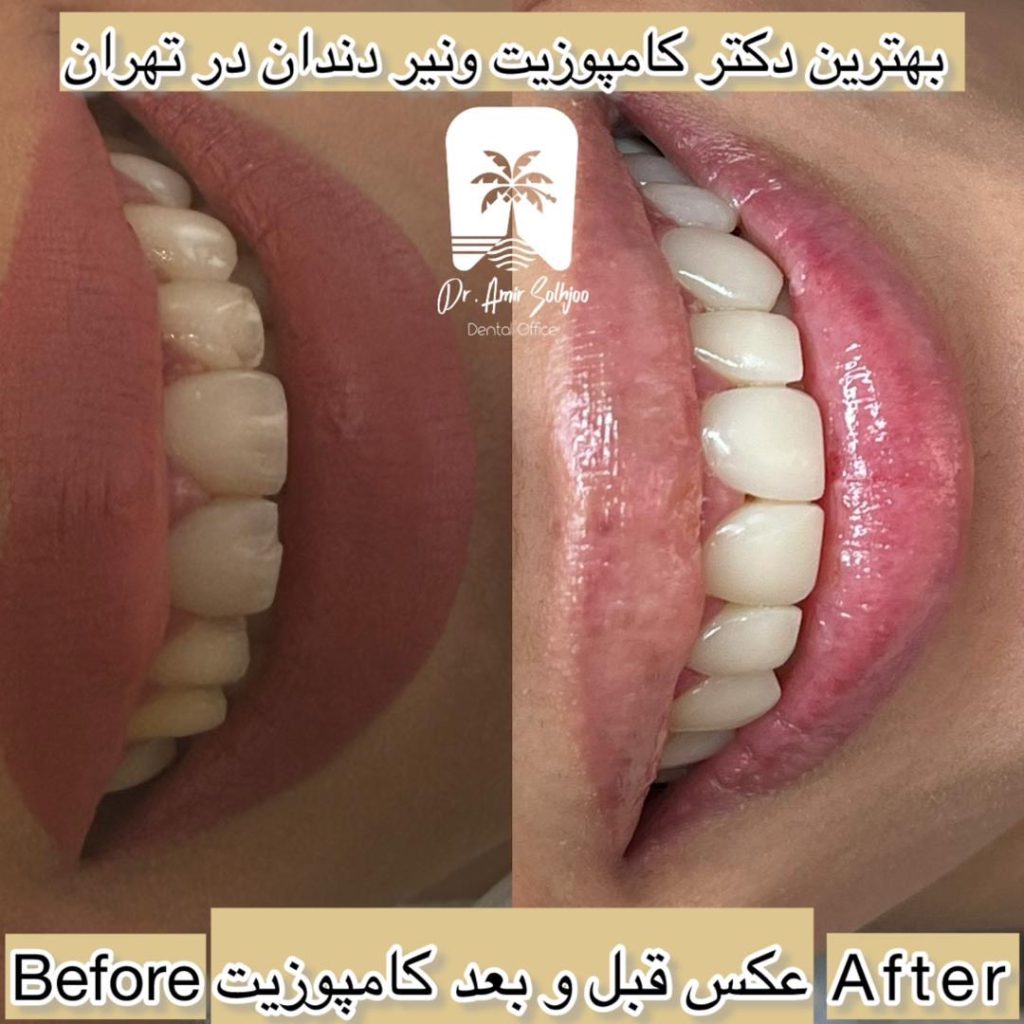 بهترین مرکز کامپوزیت دندان