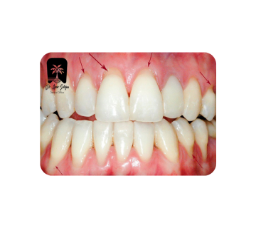 تشخیص کامپوزیت