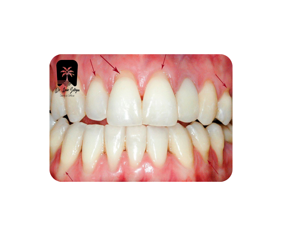تشخیص کامپوزیت