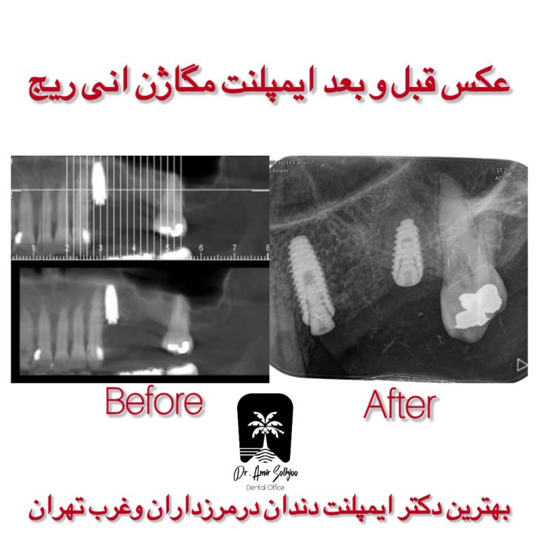 ایمپلنت دندان