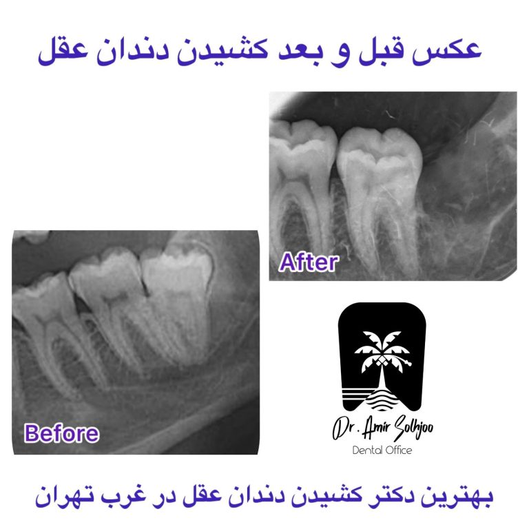 کشیدن دندان عقل