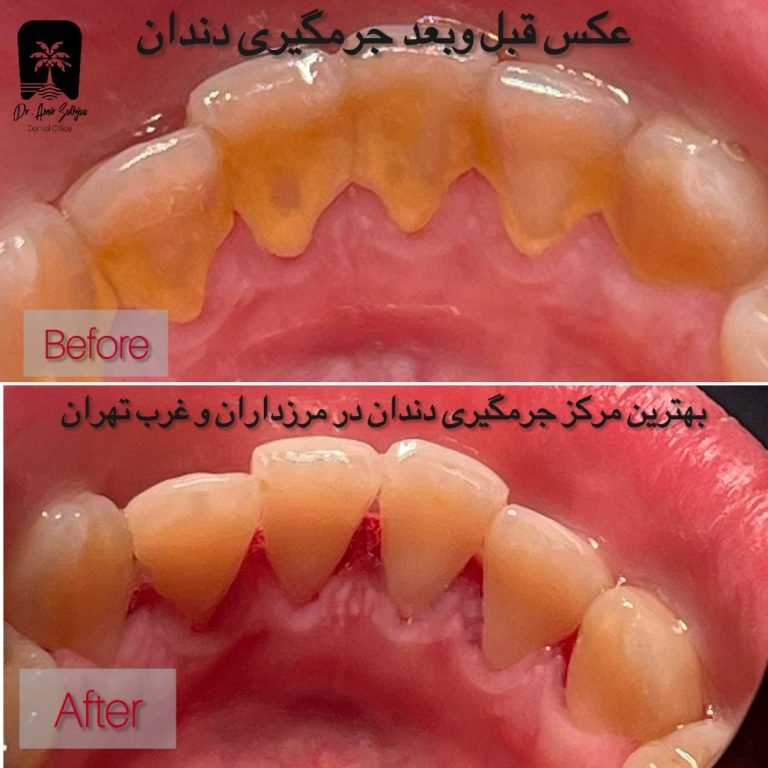 جرمگیری دندان