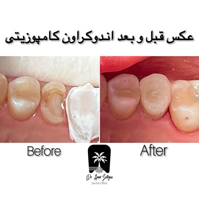 اندو کراون کامپوزیتی