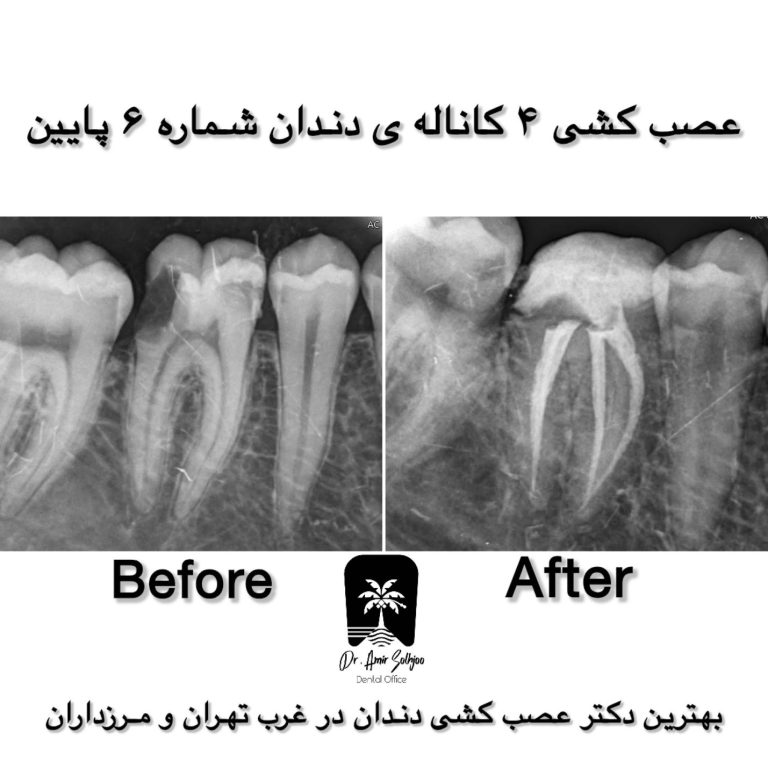 عصب کشی