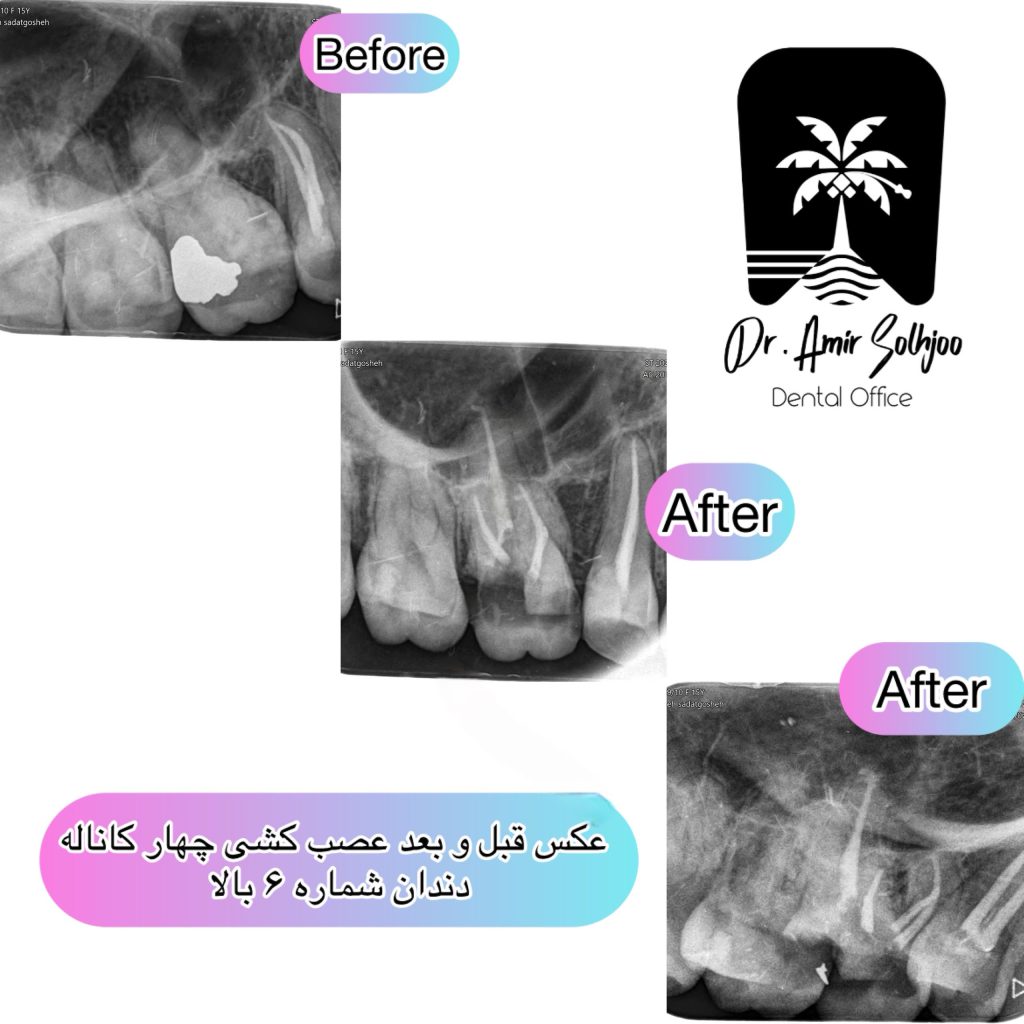 قیمت عصب کشی چهار کاناله